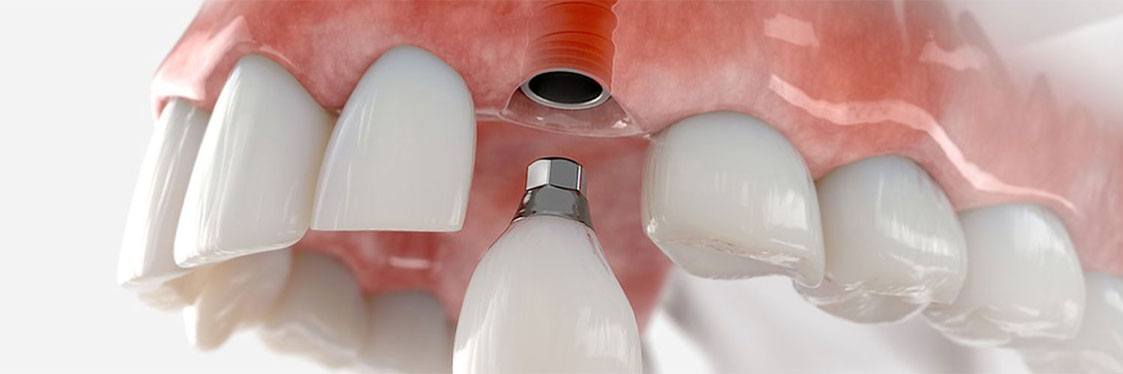 Dental Implants in Uxbridge