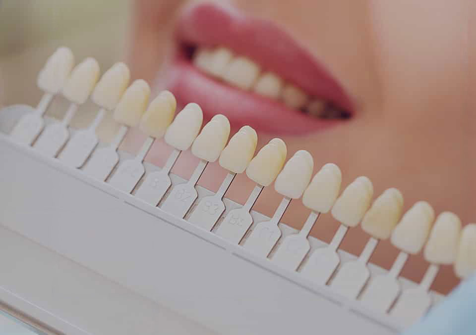Veneers in Uxbridge