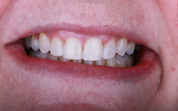 invisalign and Bonding before after