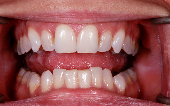 invisalign and Bonding before after