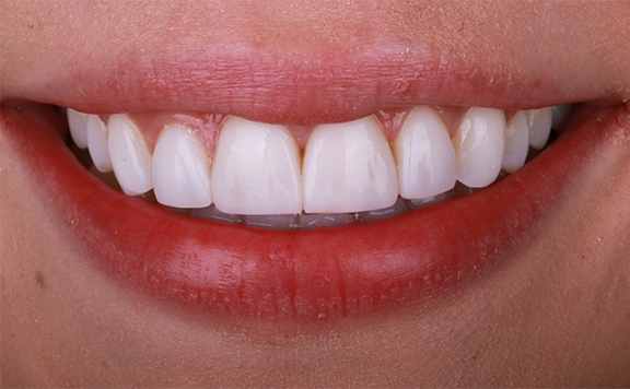 Resin veneers before after
