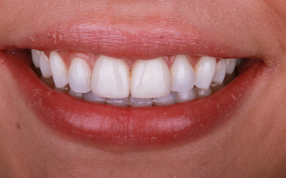 Resin veneers before after