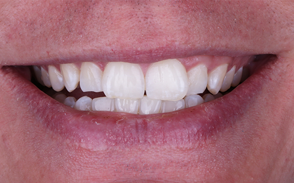 invisalign before after