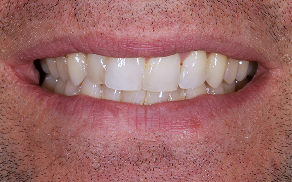 invisalign before after