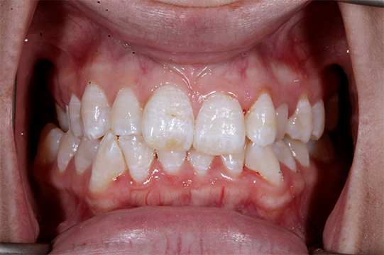 invisalign before after