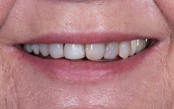 veneers before after