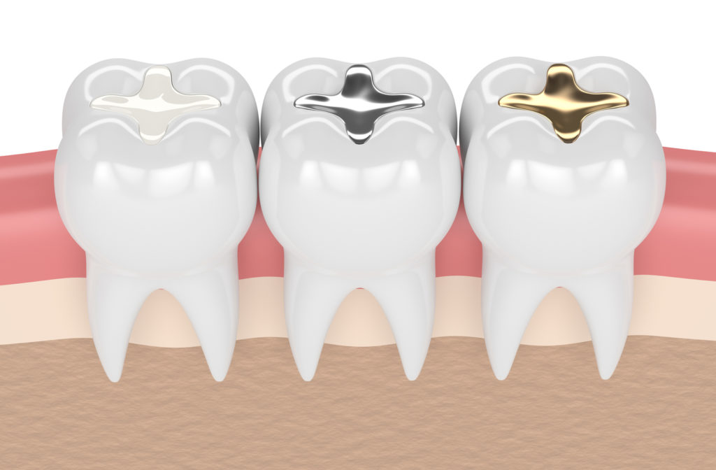 3D illustration of dental fillings showing gold, amalgam and composite inlay fillings