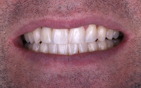 invisalign After