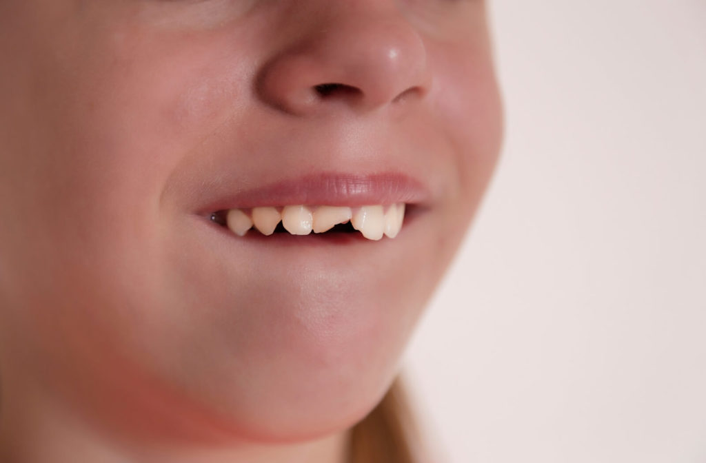 a close up image of a child whose front tooth has cracked in half horizontally
