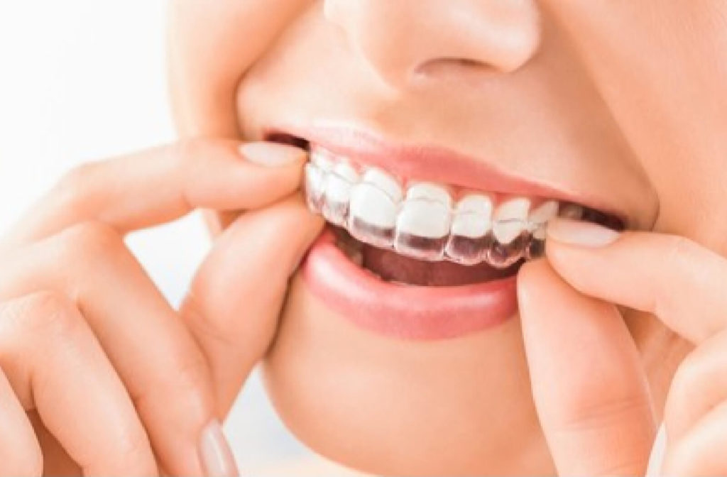 A close-up of a woman wearing a clear braces aligner. You may not be able to enjoy the foods and drinks you love as much because of them. Water is the best drink to have with Invisalign.